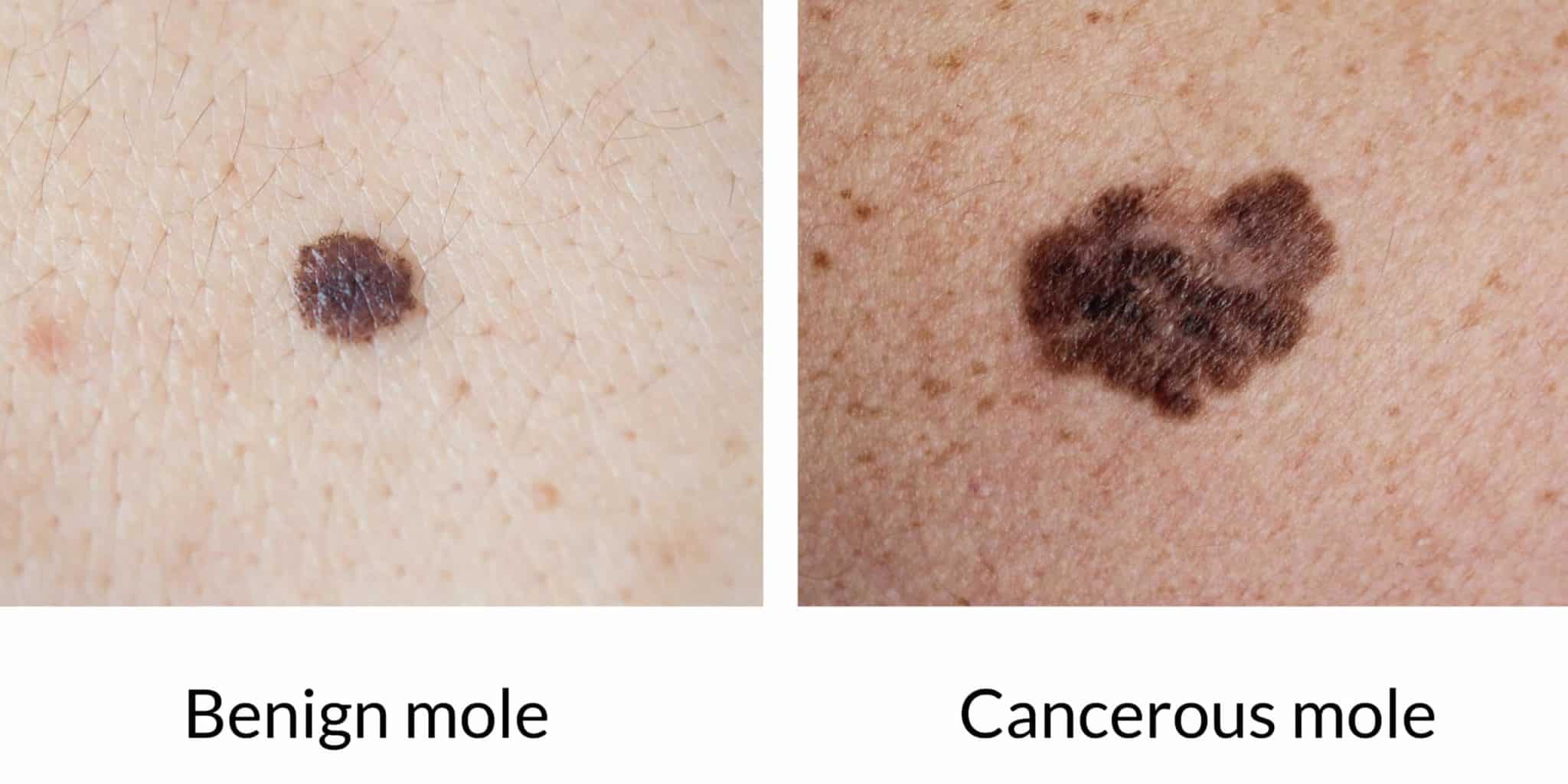 cancerous black moles