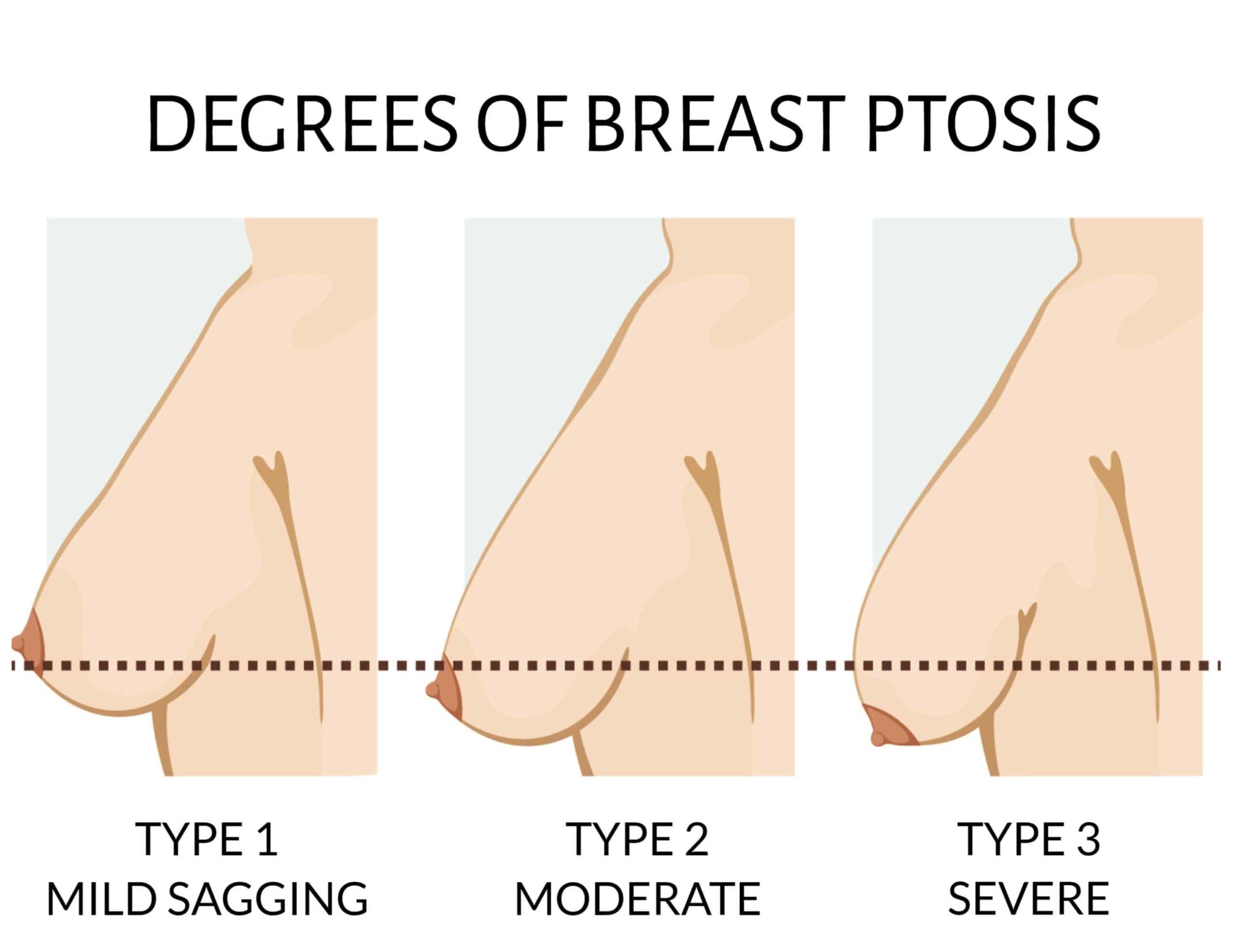 Do men care if a woman's breasts are sagging? Do they prefer women