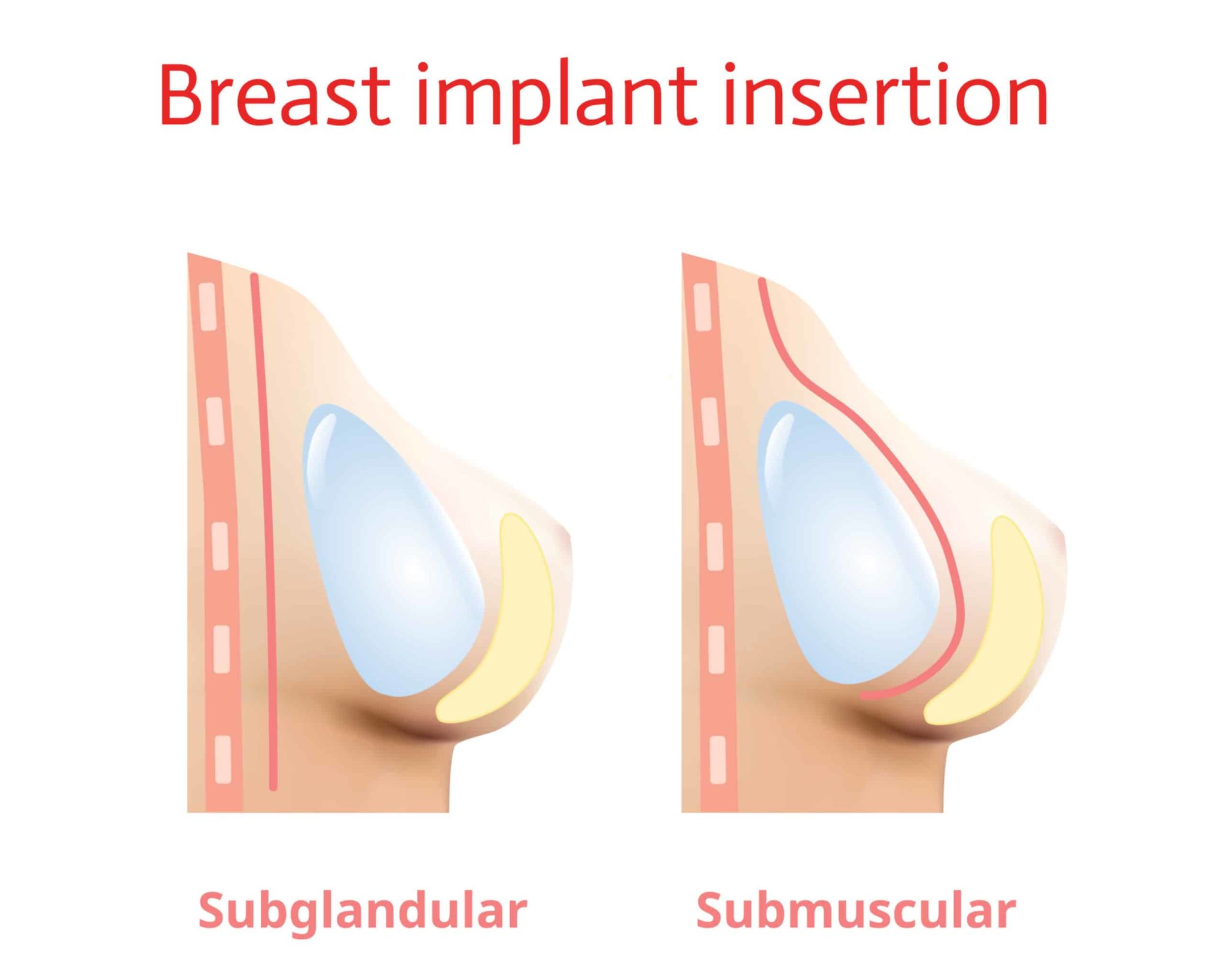Should I get breast implants under the muscle or over?