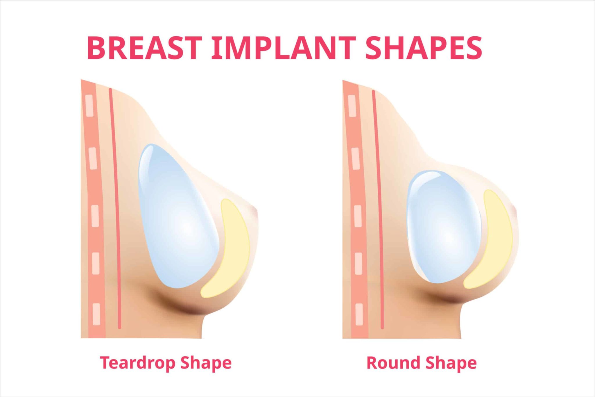 Teardrop vs round breast implants: what's the difference? - Harley