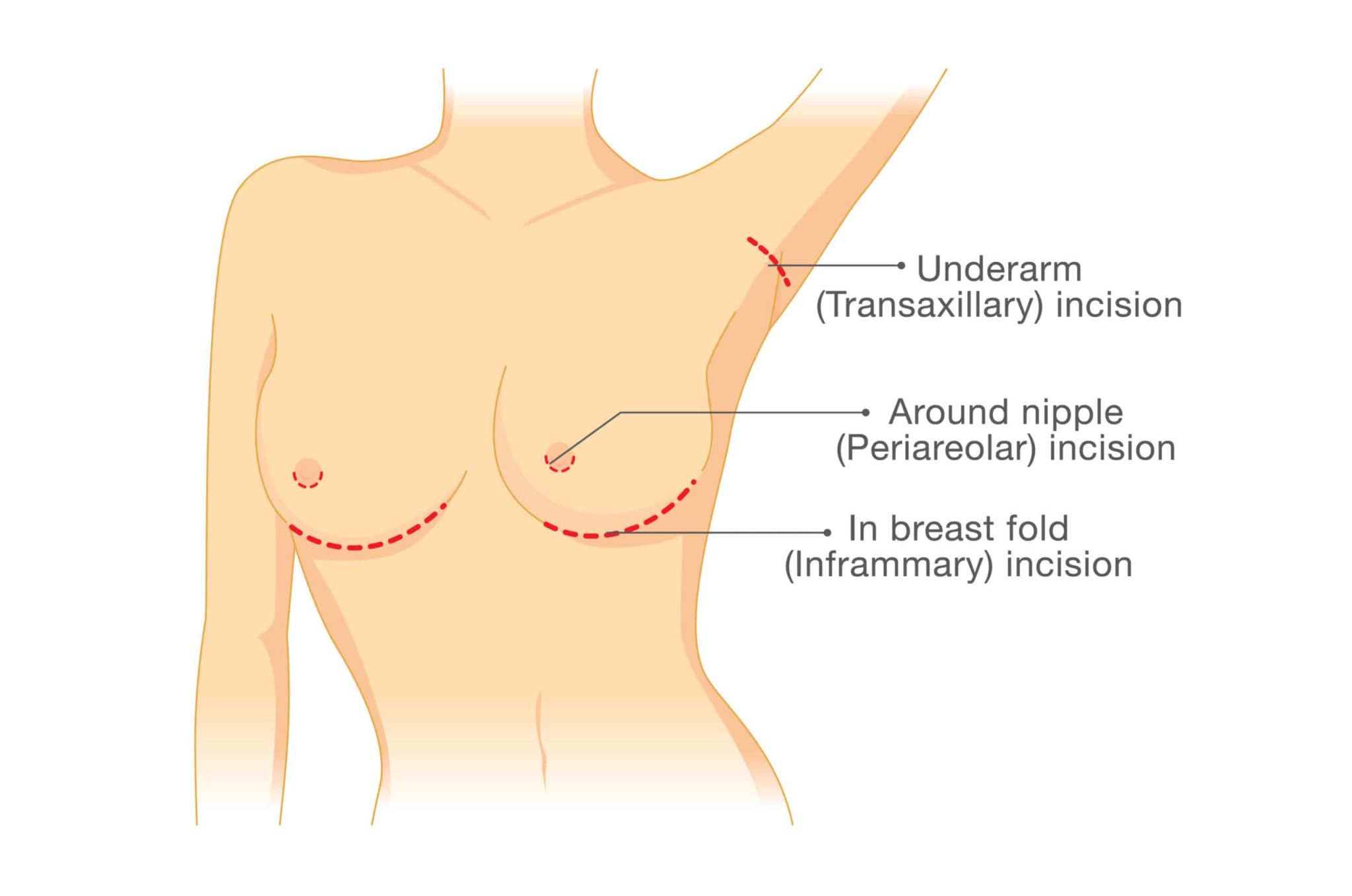 Breast Augmentation and Nipples