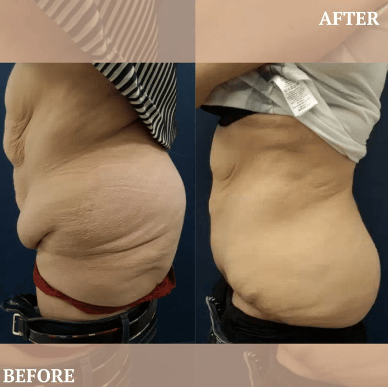 Liposuction vs Tummy Tuck: The Differences