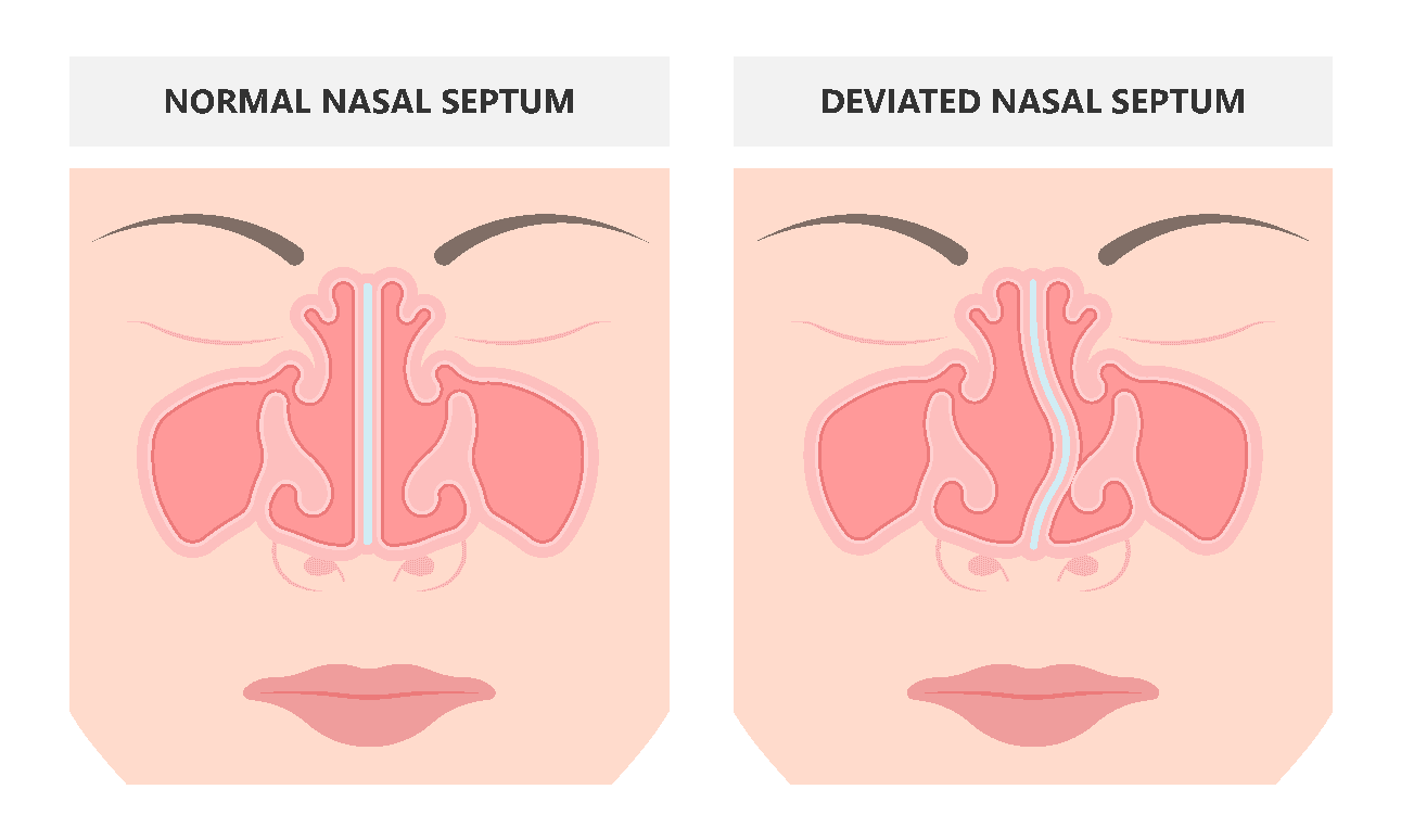 Deviated Septum Surgery Are You Struggling To Breathe