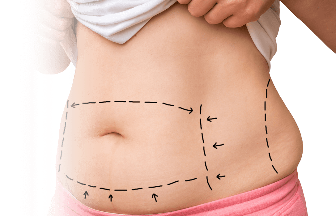 Dr. Parker Talks Tummy Tucks: Figuring Out a Treatment Plan for