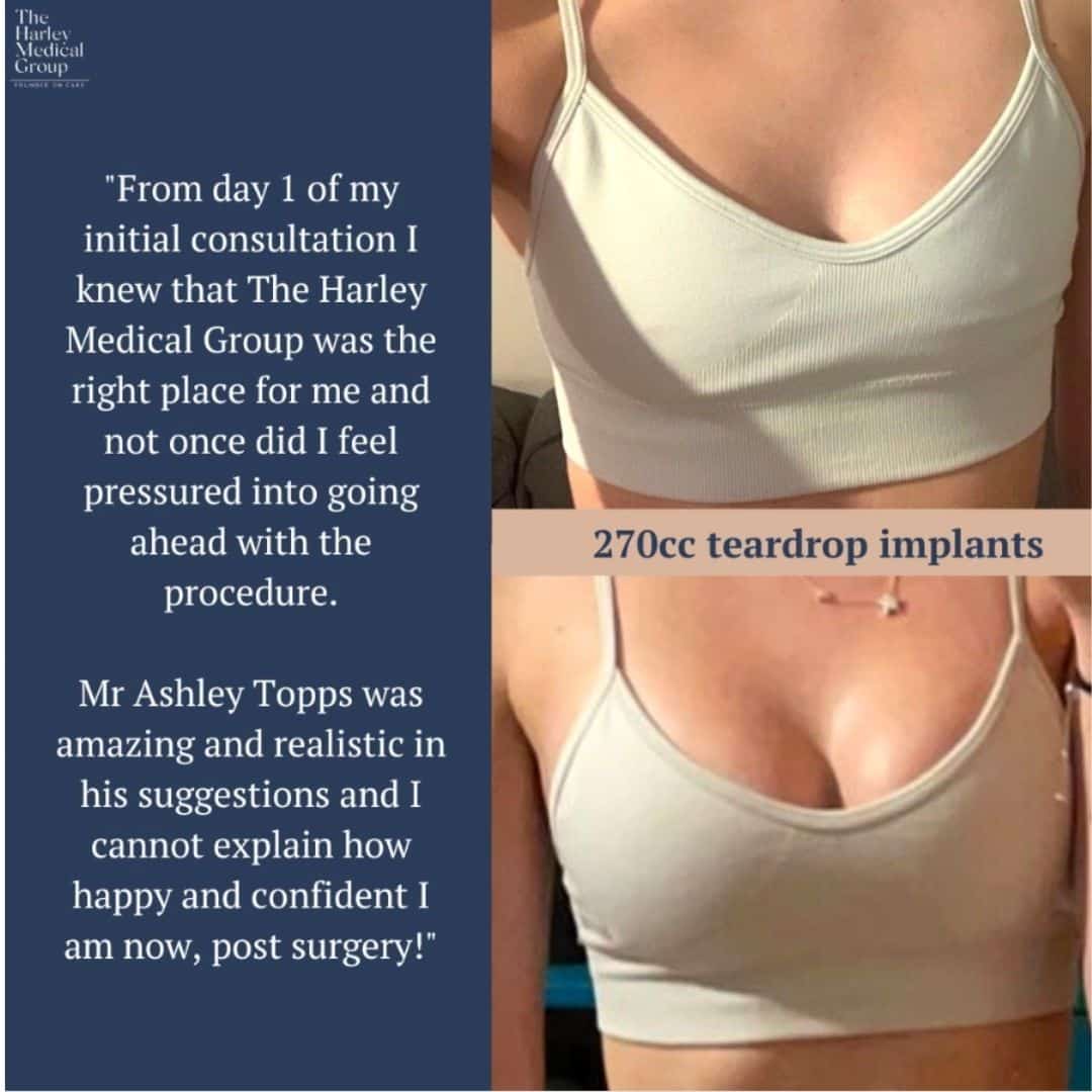 Boob Job - Breast Augmentation
